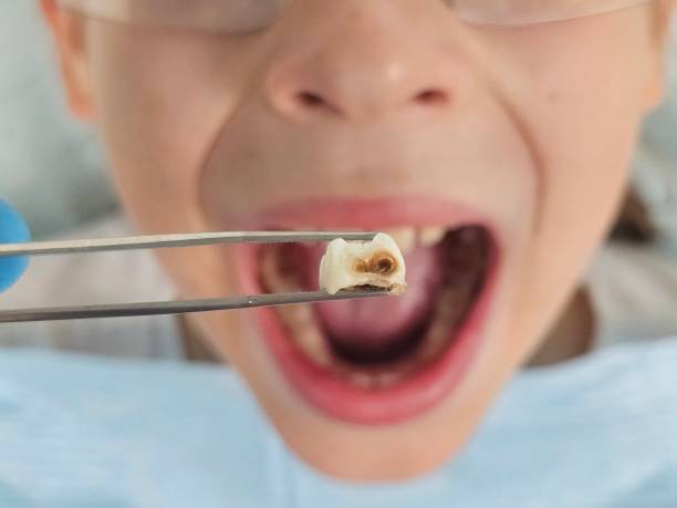 Best Emergency Tooth Extraction in Bowmansville, PA